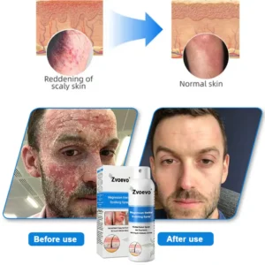 Zvoevo® Magnesium Herbal Psoriasis Spray