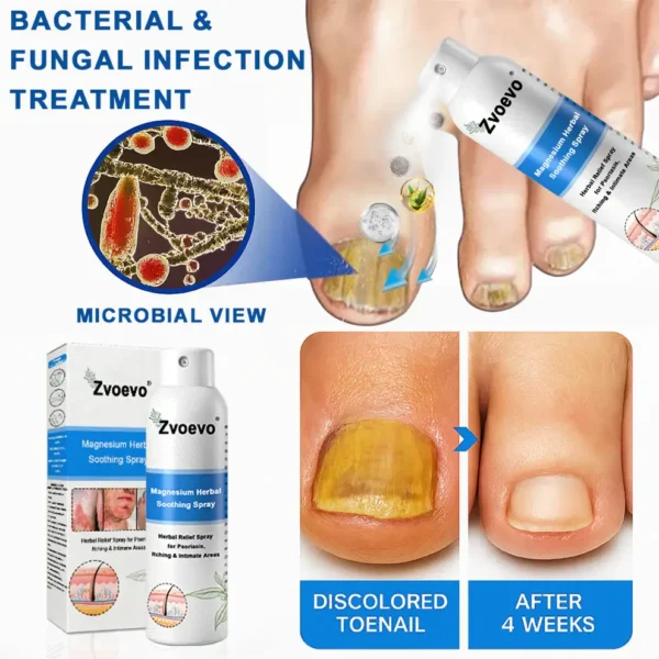 Zvoevo® Magnesium Herbal Psoriasis Spray