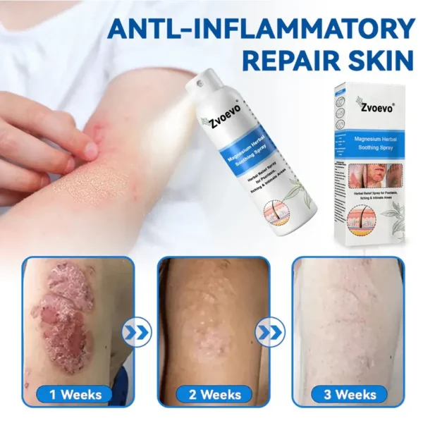 Zvoevo® Magnesium Herbal Psoriasis Spray
